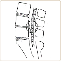 椎間板ヘルニアのイメージ図