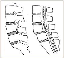 脊椎分離およびすべり症のイメージ図