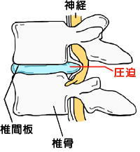 椎間板が変形して神経を圧迫しているイメージイラスト